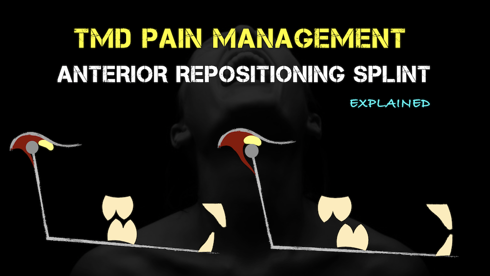 TMD Management Anterior Repositioning Splint Explained
