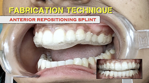 TMD: Fabrication Technique for Anterior Repositioning Splint
